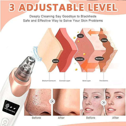 5 in 1 Blackhead Remover machine, Powerful Pimple Pore Cleaner, Vacuum Suction Tool